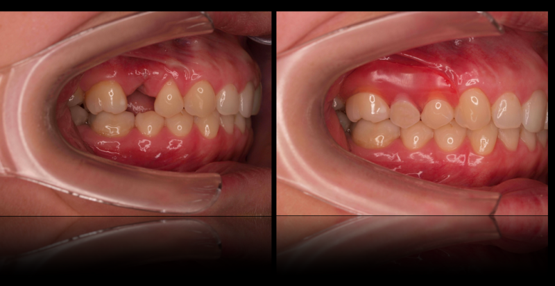 Valplast partial denture