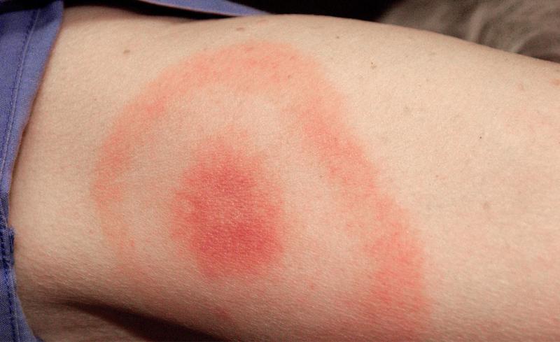 Lyme disease is usually diagnosed through the presence of a target, or bulls-eye rash more than two inches in diameter. Other symptoms of Lyme disease include flu-like symptoms, a stiff neck, chills, fever, swollen lymph nodes, headaches and joint pain. Courtesy photo